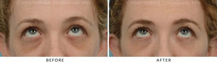 Fillers to treat lower eyelid hollowing Before & After Photo - Patient Seeing Up - Patient 14A