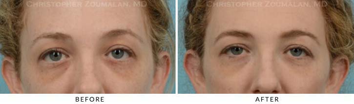 Fillers to treat lower eyelid hollowing Before & After Photo - Patient Seeing Straight - Patient 14B