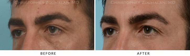 Fillers to treat lower eyelid hollowing Before & After Photo - Patient Seeing Side - Patient 15