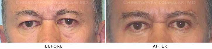 Fillers to treat lower eyelid hollowing Before & After Photo - Patient Seeing Straight - Patient 16A