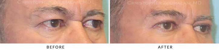 Fillers to treat lower eyelid hollowing Before & After Photo - Patient Seeing Side - Patient 16B