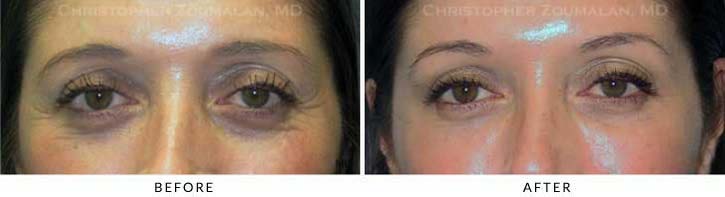 Fillers to treat lower eyelid hollowing Before & After Photo - Patient Seeing Straight - Patient 17