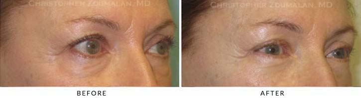 Fillers to treat lower eyelid hollowing Before & After Photo - Patient Seeing Side - Patient 18A