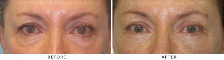Fillers to treat lower eyelid hollowing Before & After Photo - Patient Seeing Straight - Patient 18B