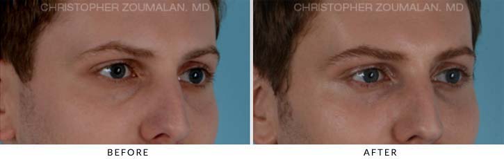 Fillers to treat lower eyelid hollowing Before & After Photo - Patient Seeing Side - Patient 1A