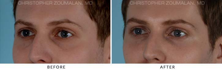 Fillers to treat lower eyelid hollowing Before & After Photo - Patient Seeing Side - Patient 1B