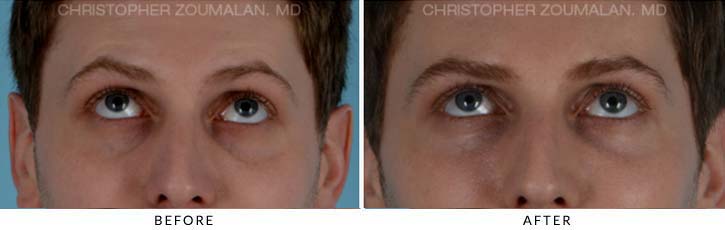 Fillers to treat lower eyelid hollowing Before & After Photo - Patient Seeing Up - Patient 1C