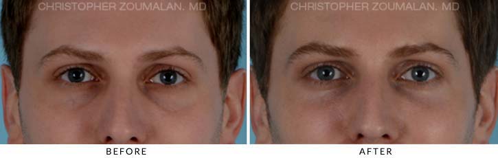 Fillers to treat lower eyelid hollowing Before & After Photo - Patient Seeing Straight - Patient 1D