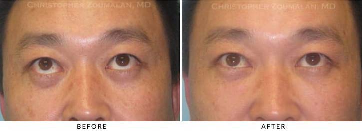 Fillers to treat lower eyelid hollowing Before & After Photo - Patient Seeing Straight - Patient 20