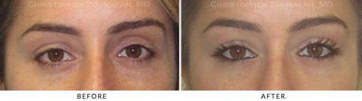 Fillers to treat lower eyelid hollowing Before & After Photo - Patient Seeing Straight - Patient 19