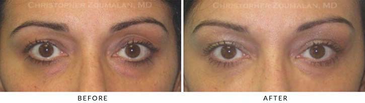 Fillers to treat lower eyelid hollowing Before & After Photo - Patient Seeing Straight - Patient 21