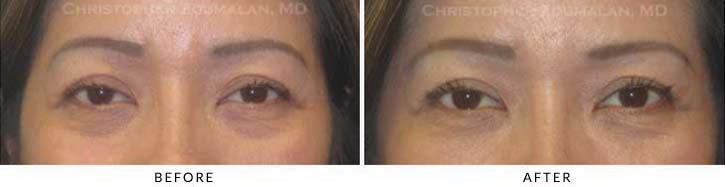 Fillers to treat lower eyelid hollowing Before & After Photo - Patient Seeing Straight - Patient 22A