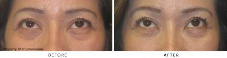 Fillers to treat lower eyelid hollowing Before & After Photo - Patient Seeing Up - Patient 22B