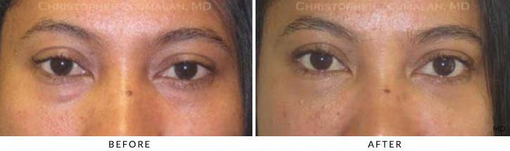 Fillers to treat lower eyelid hollowing Before & After Photo - Patient Seeing Straight - Patient 23