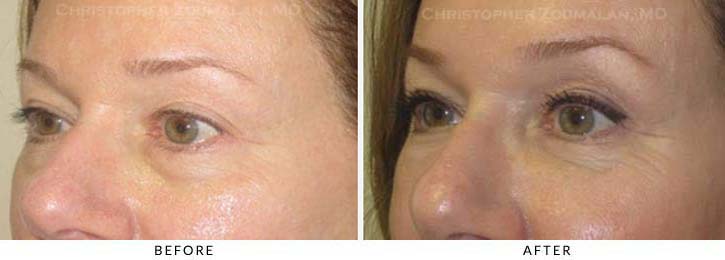 Fillers to treat lower eyelid hollowing Before & After Photo - Patient Seeing Side - Patient 24