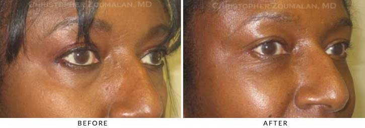 Fillers to treat lower eyelid hollowing Before & After Photo - Patient Seeing Side - Patient 25