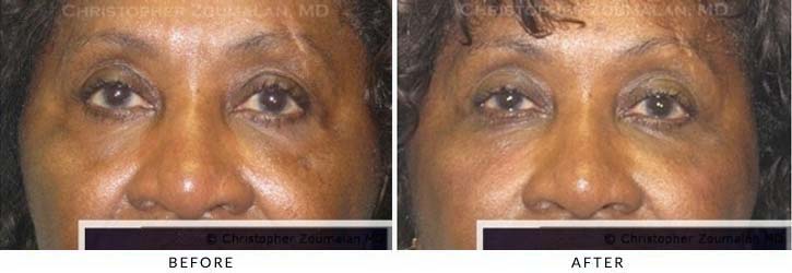 Fillers to treat lower eyelid hollowing Before & After Photo - Patient Seeing Straight - Patient 26A
