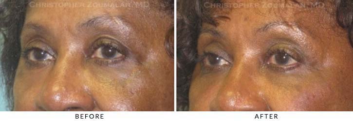 Fillers to treat lower eyelid hollowing Before & After Photo - Patient Seeing Side - Patient 26B