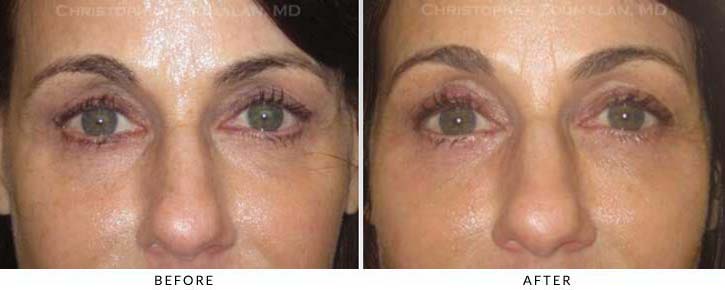 Fillers to treat lower eyelid hollowing Before & After Photo - Patient Seeing Straight - Patient 27