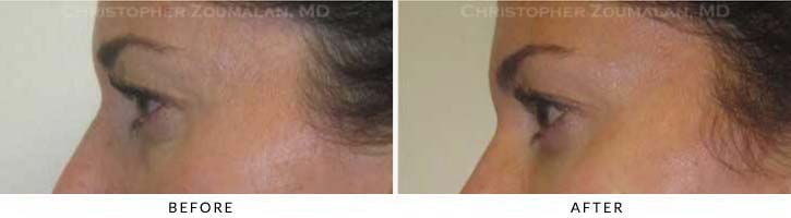 Fillers to treat lower eyelid hollowing Before & After Photo - Patient Seeing Side - Patient 28