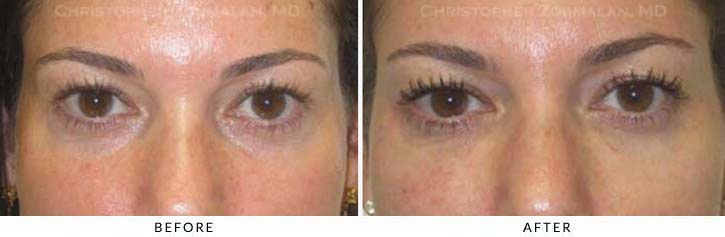 Fillers to treat lower eyelid hollowing Before & After Photo - Patient Seeing Straight - Patient 29