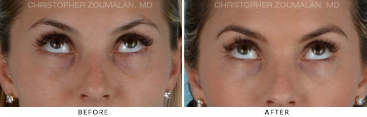 Fillers to treat lower eyelid hollowing Before & After Photo - Patient Seeing Up - Patient 2B