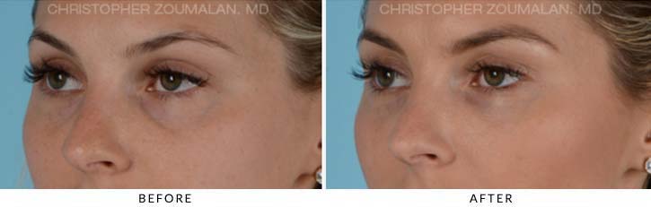 Fillers to treat lower eyelid hollowing Before & After Photo - Patient Seeing Side - Patient 2C