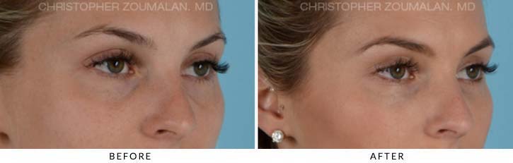 Fillers to treat lower eyelid hollowing Before & After Photo - Patient Seeing Side - Patient 2D