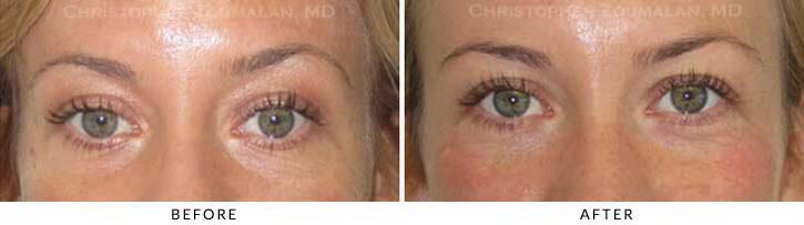 Fillers to treat lower eyelid hollowing Before & After Photo - Patient Seeing Straight - Patient 30