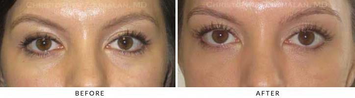 Fillers to treat lower eyelid hollowing Before & After Photo - Patient Seeing Straight - Patient 31