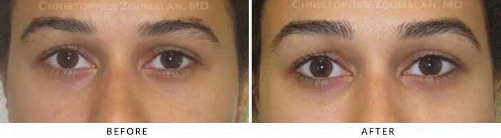Fillers to treat lower eyelid hollowing Before & After Photo - Patient Seeing Straight - Patient 32