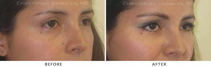 Fillers to treat lower eyelid hollowing Before & After Photo - Patient Seeing Side - Patient 33