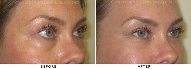 Fillers to treat lower eyelid hollowing Before & After Photo - Patient Seeing Side - Patient 35