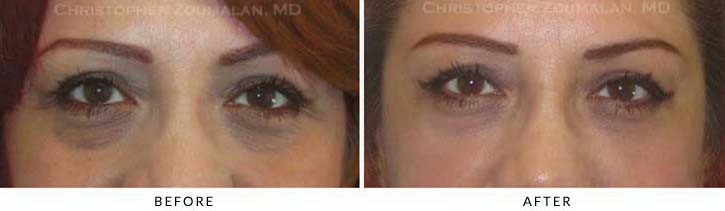 Fillers to treat lower eyelid hollowing Before & After Photo - Patient Seeing Straight - Patient 36