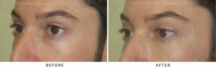 Fillers to treat lower eyelid hollowing Before & After Photo - Patient Seeing Side - Patient 38