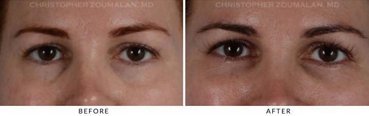 Fillers to treat lower eyelid hollowing Before & After Photo - Patient Seeing Straight - Patient 3
