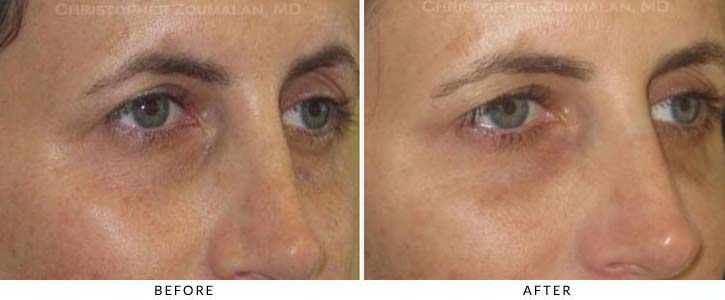 Fillers to treat lower eyelid hollowing Before & After Photo - Patient Seeing Side - Patient 41
