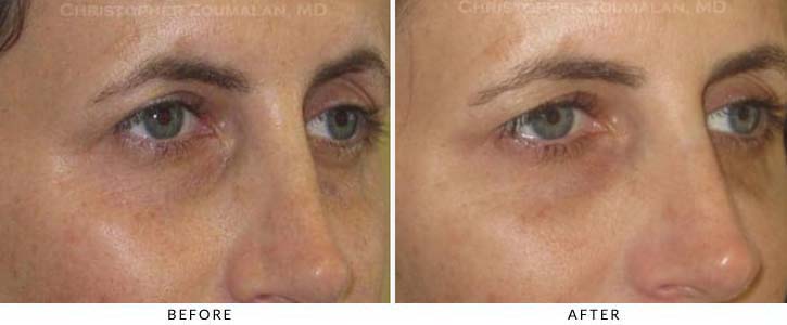 Fillers to treat lower eyelid hollowing Before & After Photo - Patient Seeing Side - Patient 41