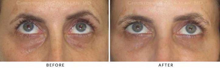 Fillers to treat lower eyelid hollowing Before & After Photo - Patient Seeing Up - Patient 42