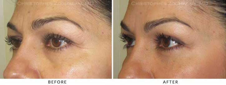 Fillers to treat lower eyelid hollowing Before & After Photo - Patient Seeing Side - Patient 44