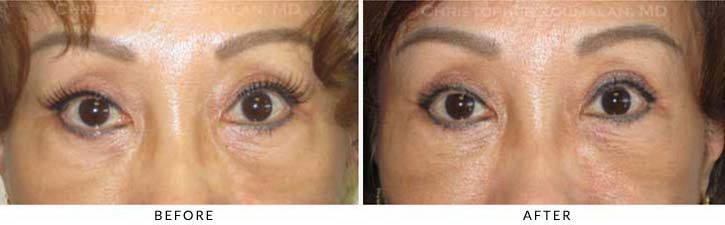 Fillers to treat lower eyelid hollowing Before & After Photo - Patient Seeing Straight - Patient 45