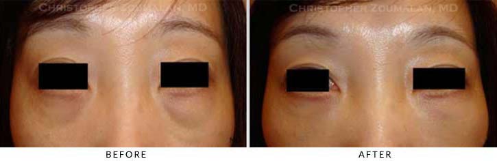 Fillers to treat lower eyelid hollowing Before & After Photo - Patient Seeing Straight - Patient 47