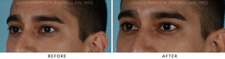 Fillers to treat lower eyelid hollowing Before & After Photo - Patient Seeing Side - Patient 4A
