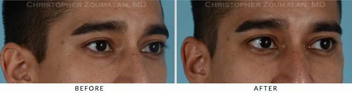 Fillers to treat lower eyelid hollowing Before & After Photo - Patient Seeing Side - Patient 4B