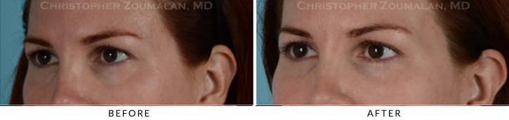 Fillers to treat lower eyelid hollowing Before & After Photo - Patient Seeing Side - Patient 5B