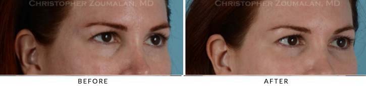 Fillers to treat lower eyelid hollowing Before & After Photo - Patient Seeing side - Patient 5C