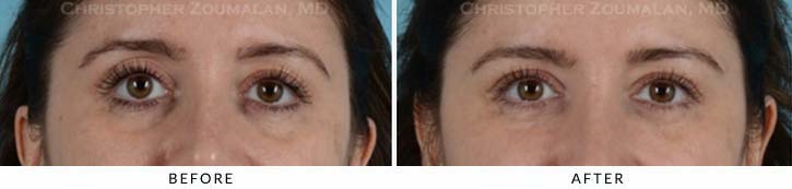 Fillers to treat lower eyelid hollowing Before & After Photo - Patient Seeing Straight - Patient 6A