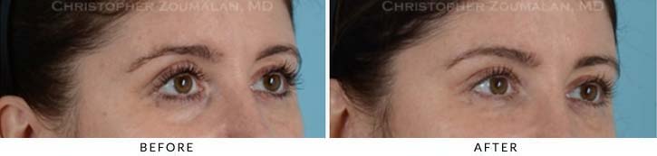 Fillers to treat lower eyelid hollowing Before & After Photo - Patient Seeing Side - Patient 6B