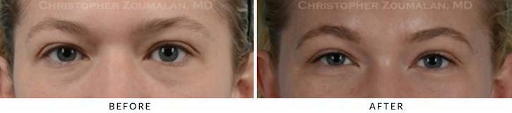 Fillers to treat lower eyelid hollowing Before & After Photo - Patient Seeing Straight - Patient 7A