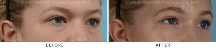 Fillers to treat lower eyelid hollowing Before & After Photo - Patient Seeing Side - Patient 7C